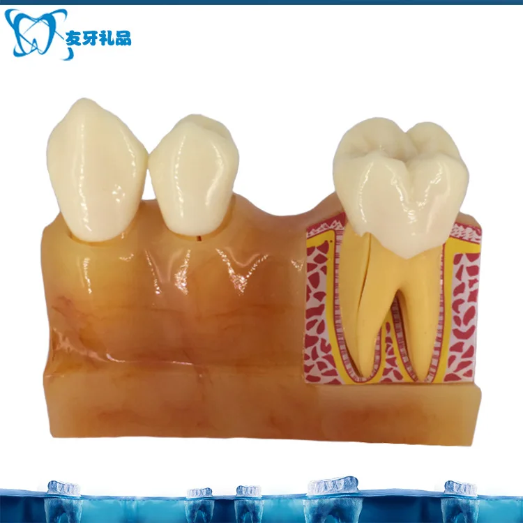 4 Times Tooth Decomposition Resin Model Dental Pulp and Anatomical Oral Cavity Model Teaching Explanation