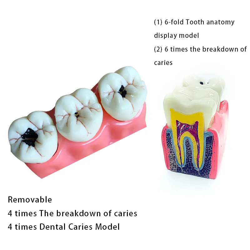 

Teeth Model Teeth Disease Teaching Model Caries Model Dental Model Dentistry Products