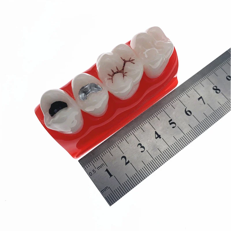 Dental Study Learn Model for Pit and Fissure Sealing Treatment Teeth Model