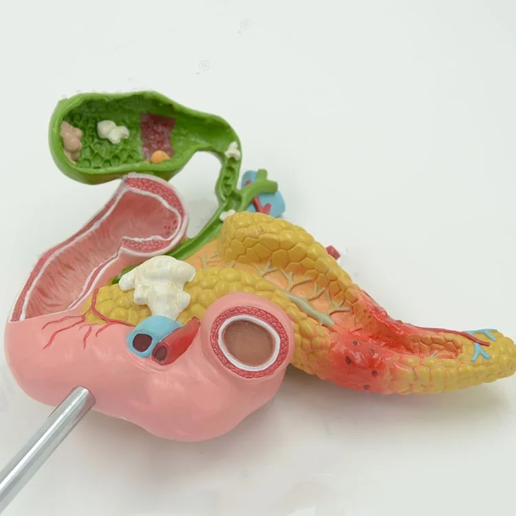 

Anatomical model of pathological structure of pancreas, duodenum and gallbladder in medical human body Surgery of internal