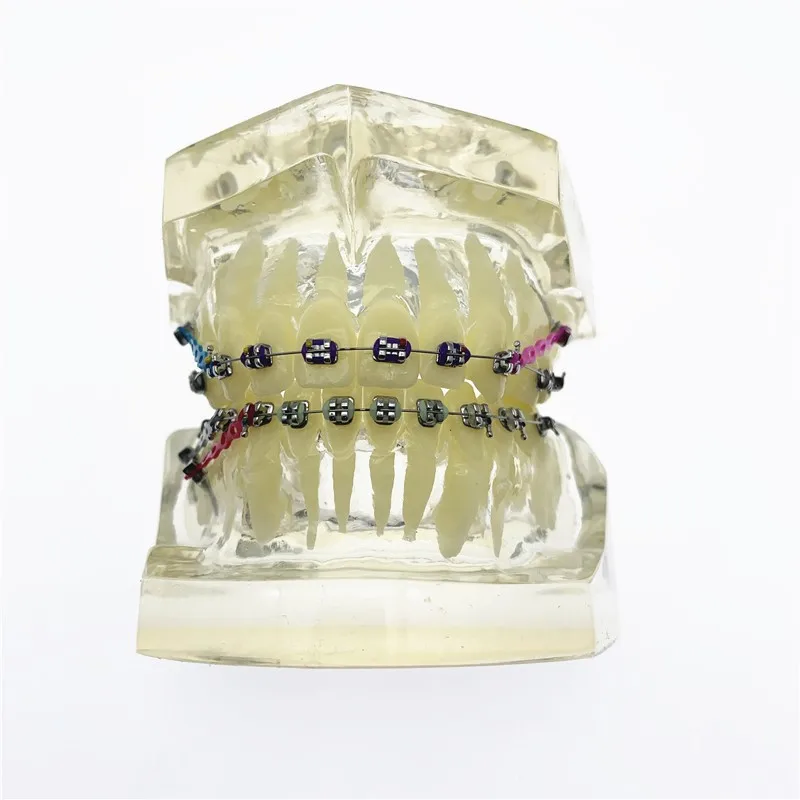 Dental Kieferorthopädische Zähne Modell Transparent Zähne Malocclusion Kieferorthopädische Modell Mit Klammern