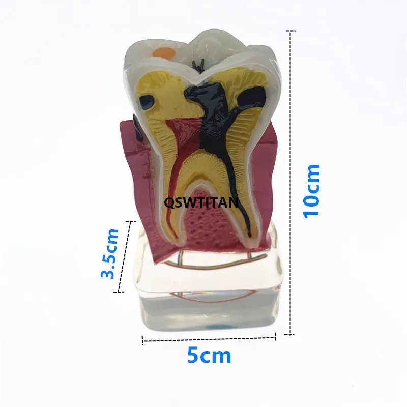 Dental Teeth Model 4 times tooth pathology model Comprehensive Periodontal Model For Teaching Study model