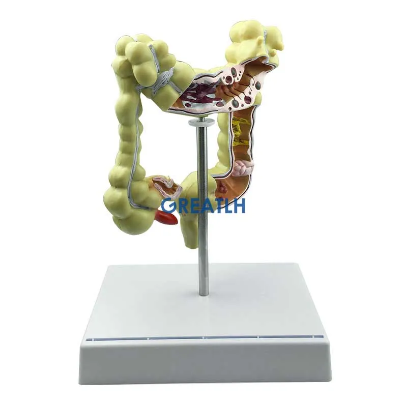 Colorectal Lesion Model Human Colon Snake Large Intestine Pathological Diseases Model Medical Organizer Anatomy