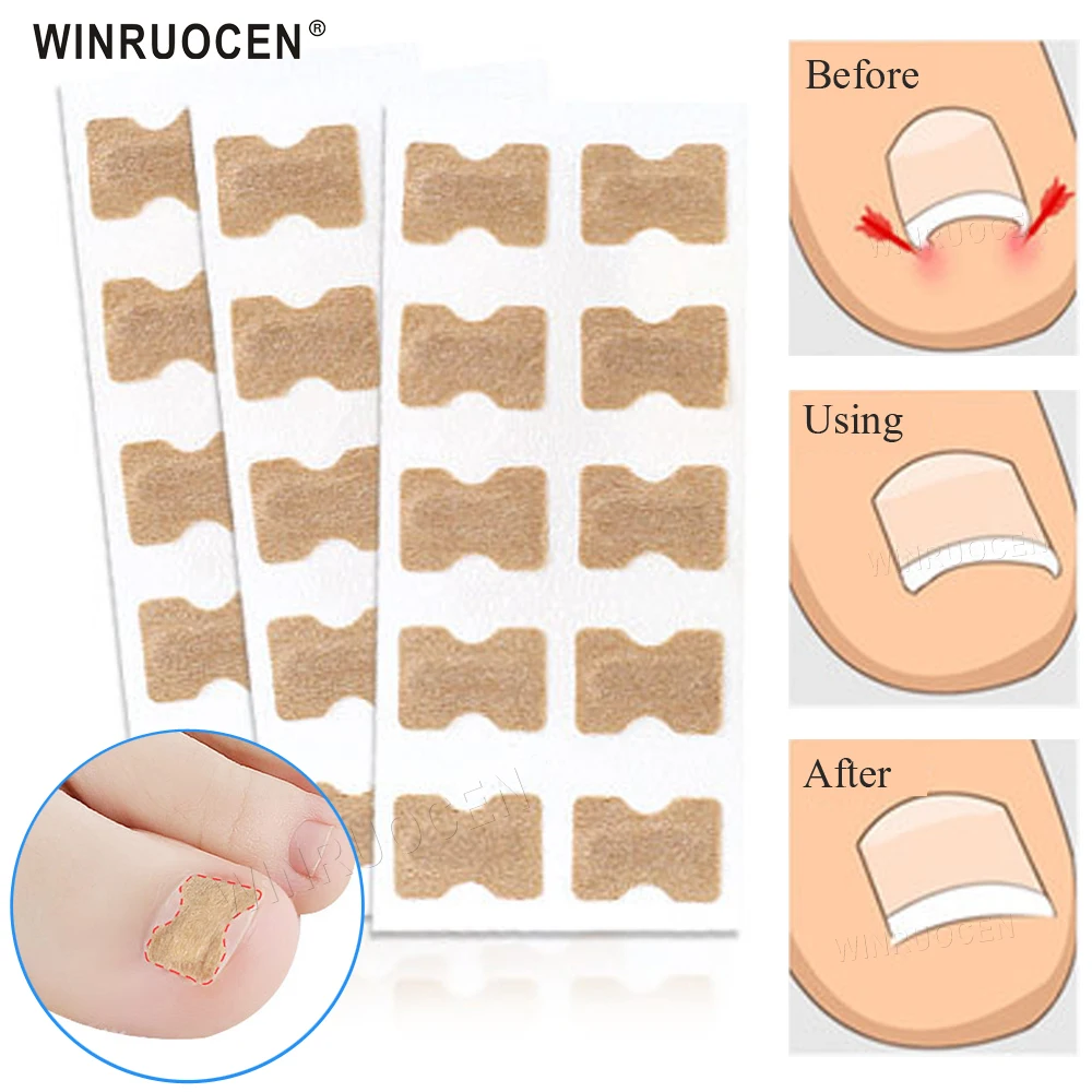 10pcs/set  Professional Ingrown Toenail Correction Tool Embedded Toe Nail Corrector Elastic Patch Sticker Pedicure Tool