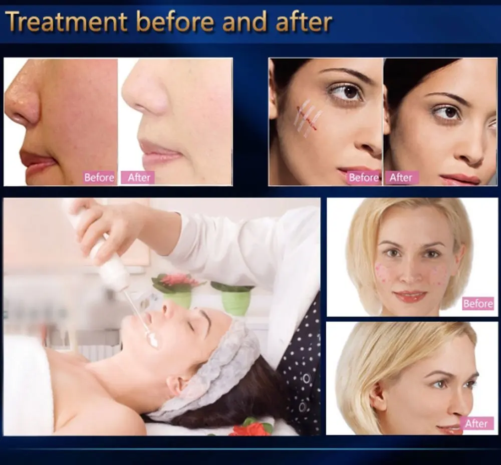 Masajeador Facial profesional 7 en 1, tubo de vidrio de electrodo, para el acné varita, cuidado de la piel, eliminador de manchas y acné