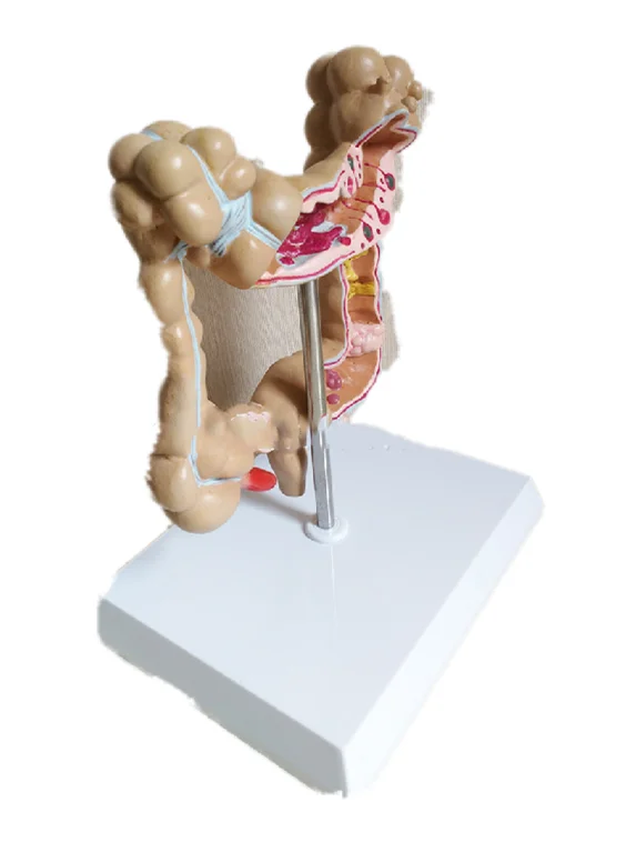 Pathological model of human large intestine ascending colon descending colon rectum cecum appendix