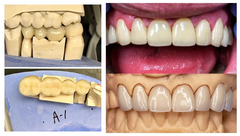 A 3,5 a4 Farben 3d mehr schicht ige Zirkon oxid blöcke leer für Cadcam Dental labor ausrüstung Stml offenes System Zirkon oxid Scheiben scheibe