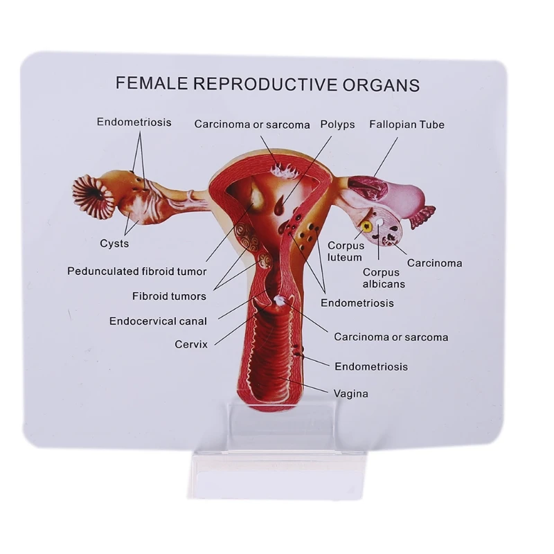 Biology Teaching, Anatomy Lesion Uterus Model, Human Female Uterus Ovary Disease Dissection Pathology Model