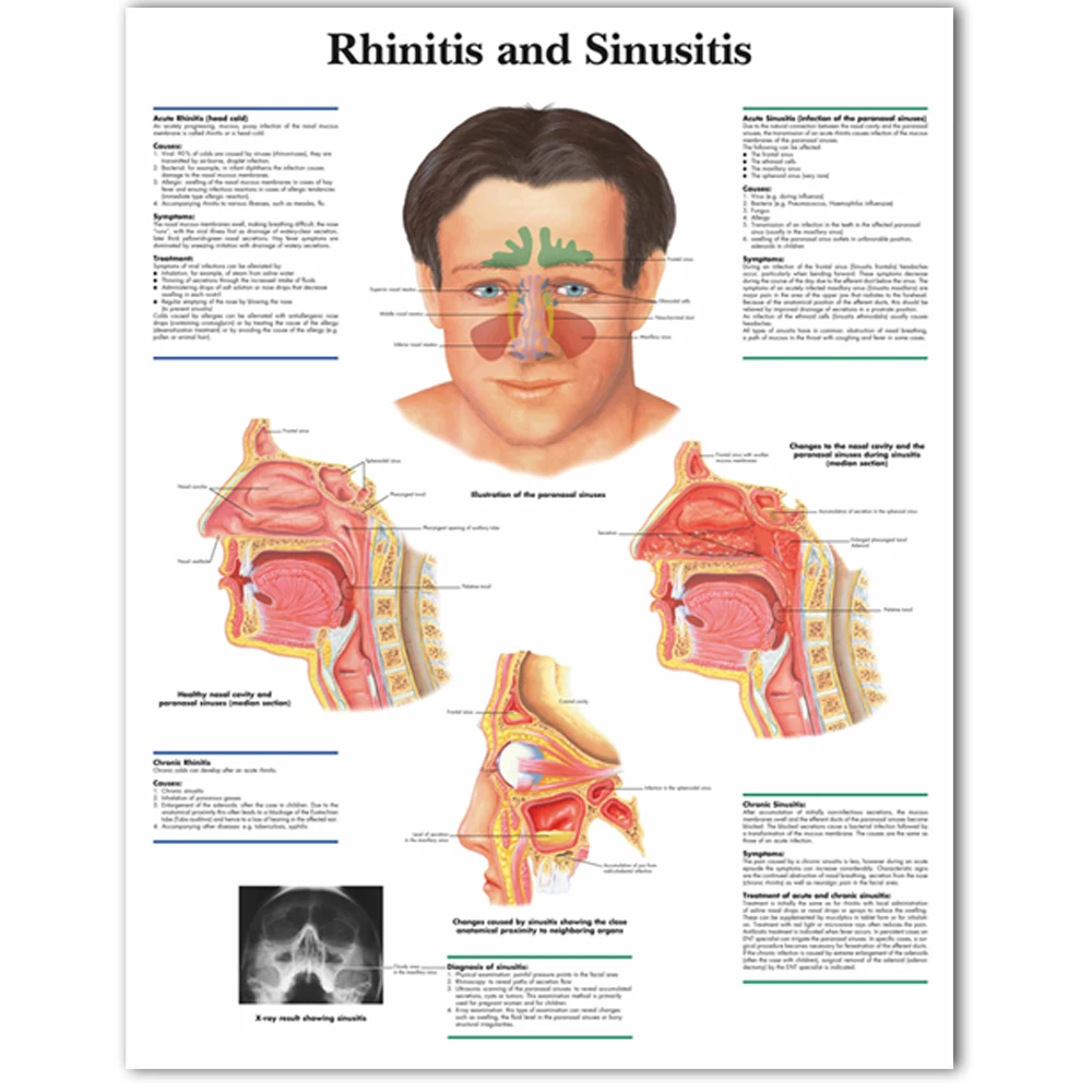 WANGART Medical Science Anatomy Rhinitis  Sinusitis Chart  Posters Canvas Print Wall Pictures for Medical Education Home Decor