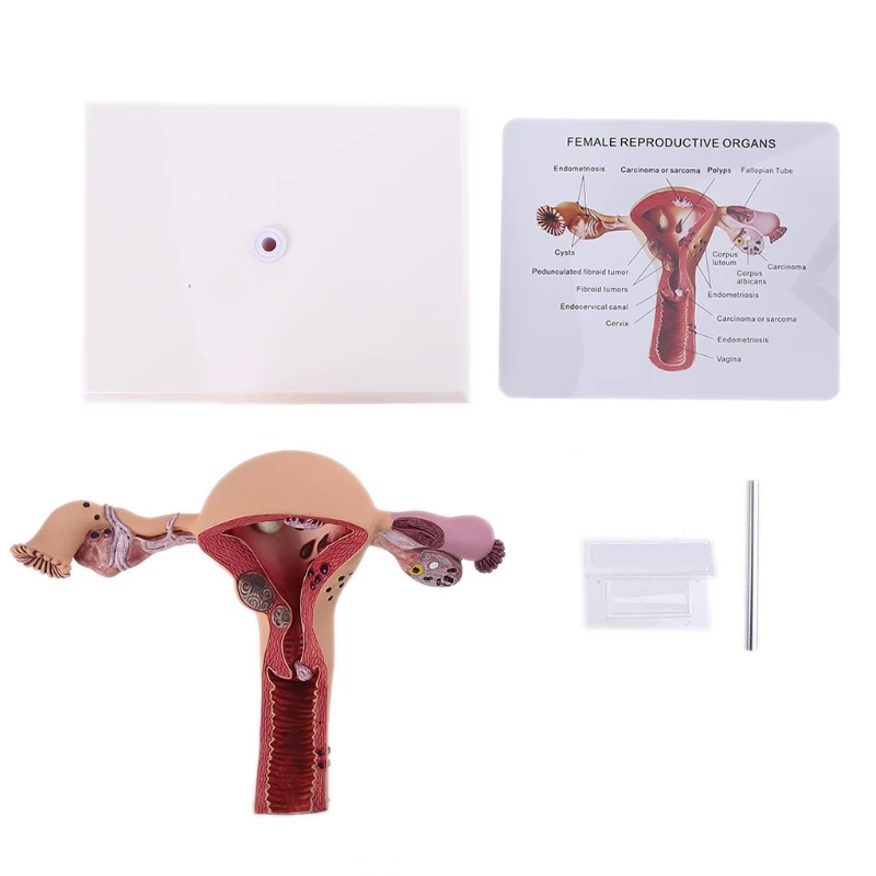 Biology Teaching, Anatomy Lesion Uterus Model, Human Female Uterus Ovary Disease Dissection Pathology Model