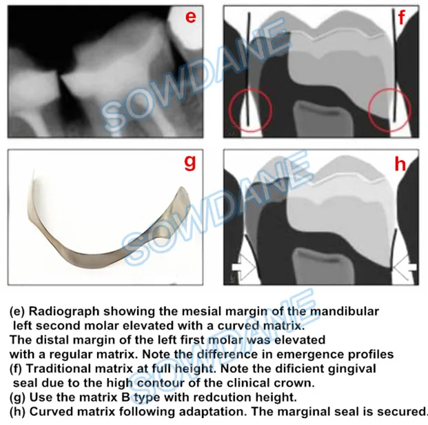 Dental Tofflemire Matrix for Deep Margin Elevation Large Curvature Matrices Retainer Sectional Contoured Matrice Dental Material