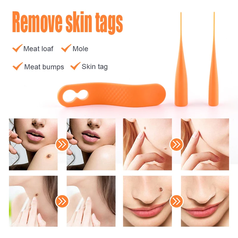 LESCOLTON مجموعة إزالة علامات الجلد 2 في 1 علامة الجلد قتل الجلد الخلد ثؤلول مزيل علامات الجلد 40 قطعة الأربطة المطاطية رأس مزدوج 2-4 مللي متر/4-7 مللي متر