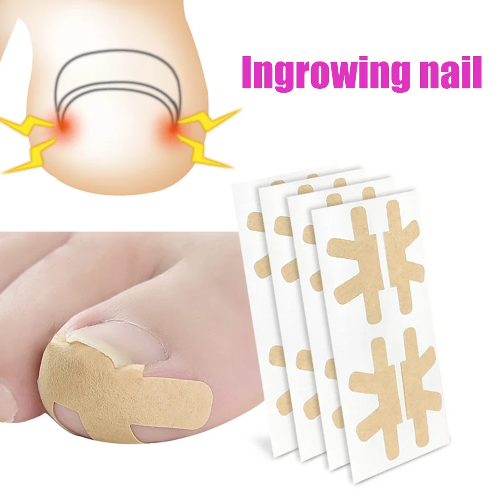 8Pcs/2Set Embedded Toe Nail Corrector Sticker Toenail Care Pedicure Thumb Curl Correction Sticker Paronychia Recover