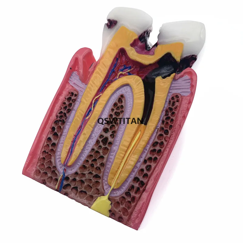 Model zębów porównanie próchnicy modele 4 razy/6 razy model próchnicy model nauczania dla studentów stomatologii