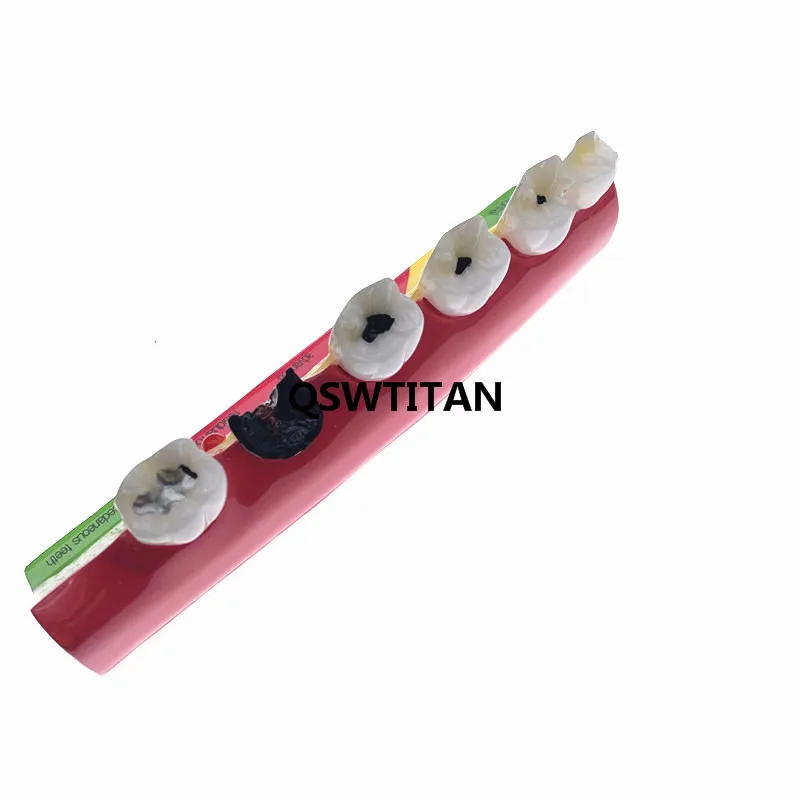 Dental Caries Classify/Evolution model Tooth Model Demonstration Dental Study Model