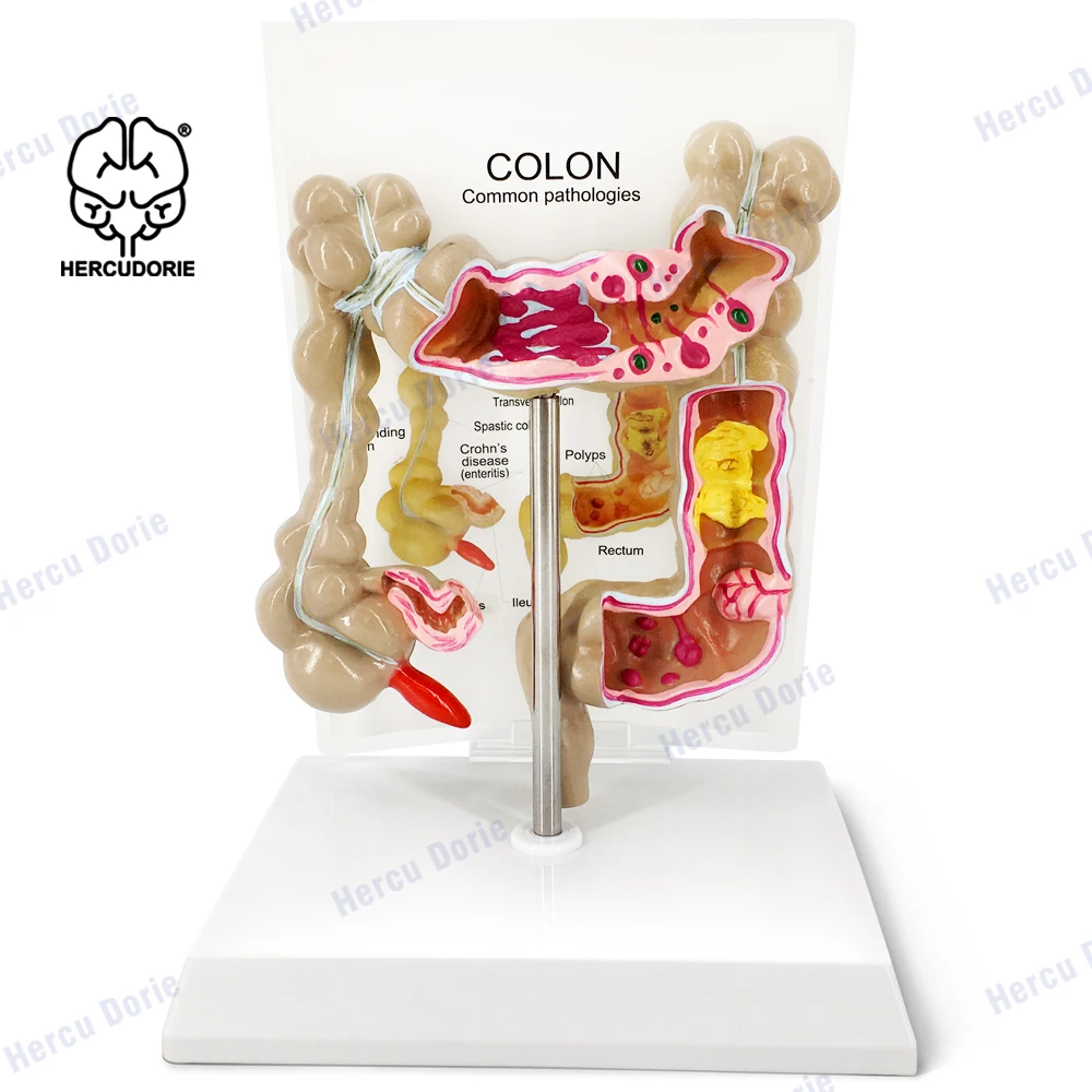 

Модель колоректального поражения человека, патологическая анатомия, болезни толстой кишки, медицинский обучающий инструмент