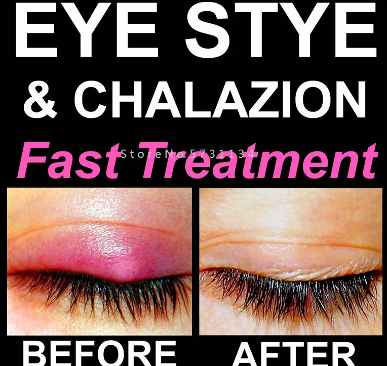 Before and After Eye Stye and Chalazion Removal Remover Relief Eyelid Bump