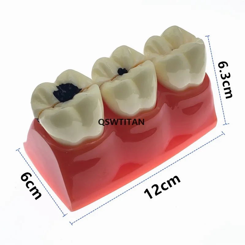 4Times Caries Models Caries teeth model for showing the progress of caries,fistula Teaching Research Model