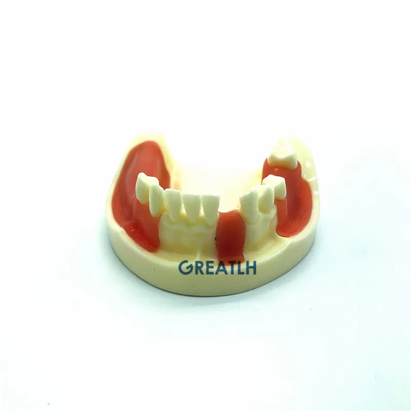 

Dental Lower Jaw model Implant Practice model Typodont Teeth Model with Gingiva