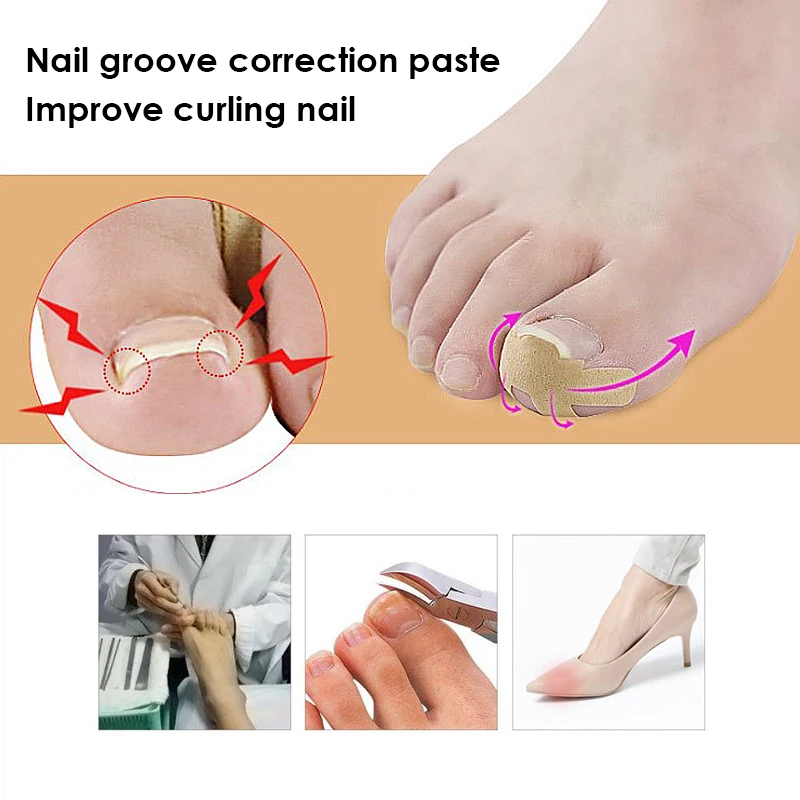 Corretor de unha profissional embutido 4-pçs, adesivo de encravado toenail, cuidados com as unhas, pedicure, polegar, curvado, pasta de correção