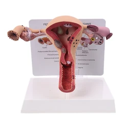 Biology Teaching, Anatomy Lesion Uterus Model, Human Female Uterus Ovary Disease Dissection Pathology Model