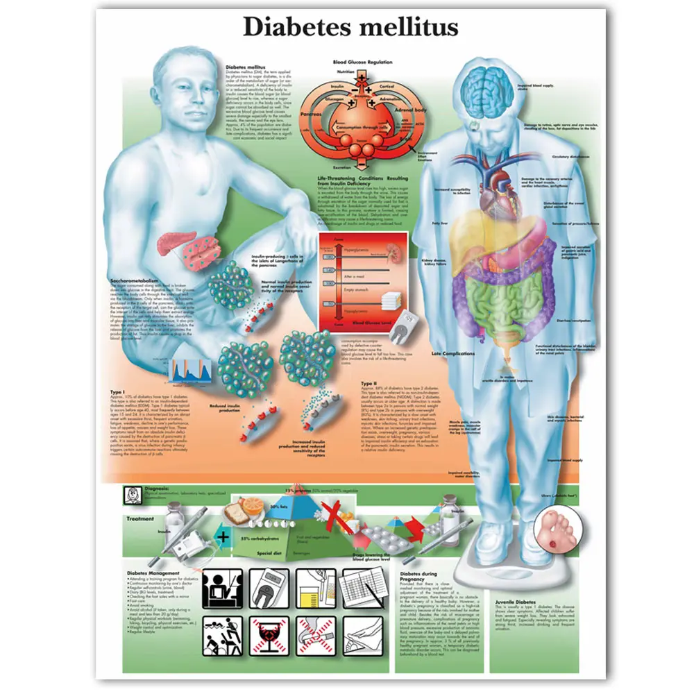 WANGART Anatomical Poster Diabetes Mellitus Chart Canvas Print Wall Picture for Medical Education