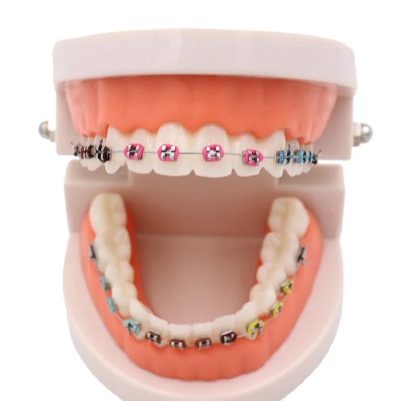 Dental Orthodontic Treatment Model With Ortho Metal Ceramic Bracket Arch Wire Buccal Tube Ligature Ties Dentist Tools Lab