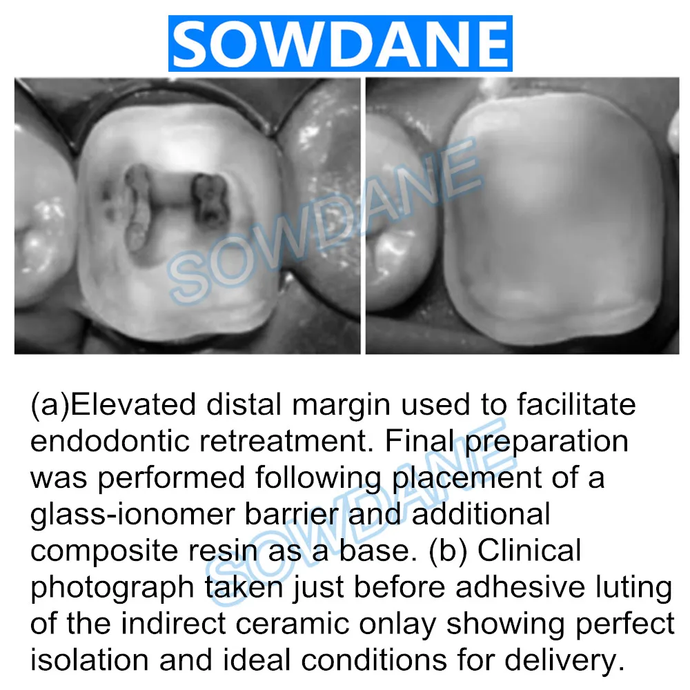 Dental Tofflemire Matrix for Deep Margin Elevation Large Curvature Matrices Retainer Sectional Contoured Matrice Dental Material