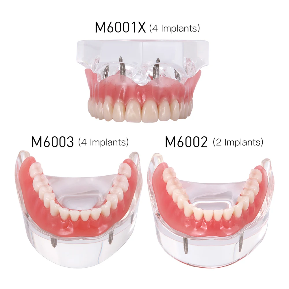 Dental Overdenture zęby Model nauczania zdejmowane wnętrze żuchwa z implantem tylko do celów demonstracyjnych