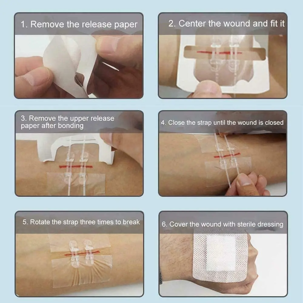 Bandages adhésifs à fermeture éclair pour les soins d'urgence des plaies, patch d'aide aux premiers secours, fermetures de la muqueuse cutanée, sutures au point, 6x7cm