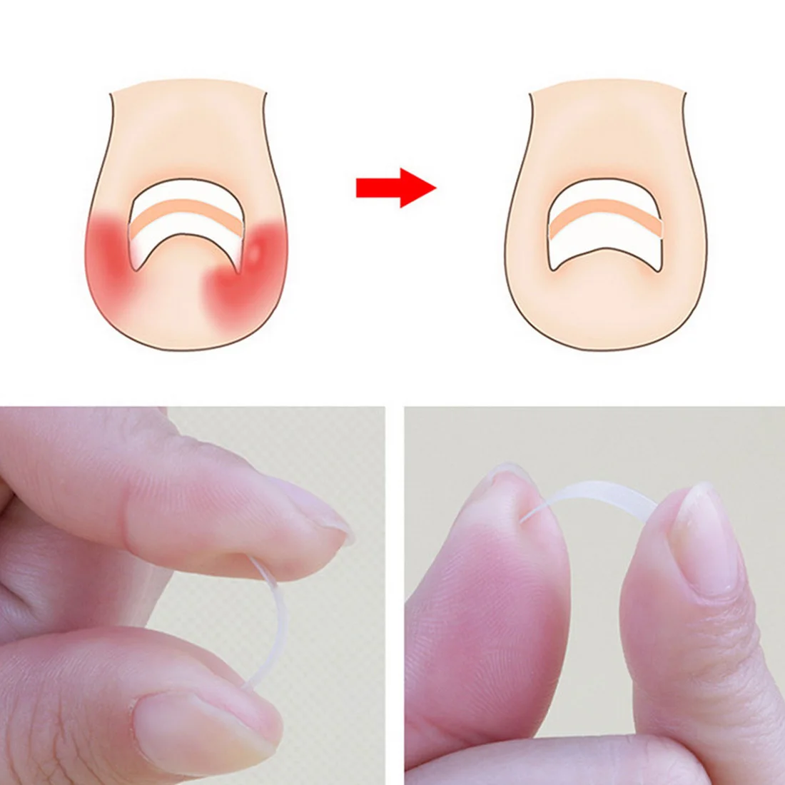 Outil de Correction des ongles incarnés, 10 pièces, Patch élastique de traitement des ongles incarnés, Clip de redressement, outil de pédicure