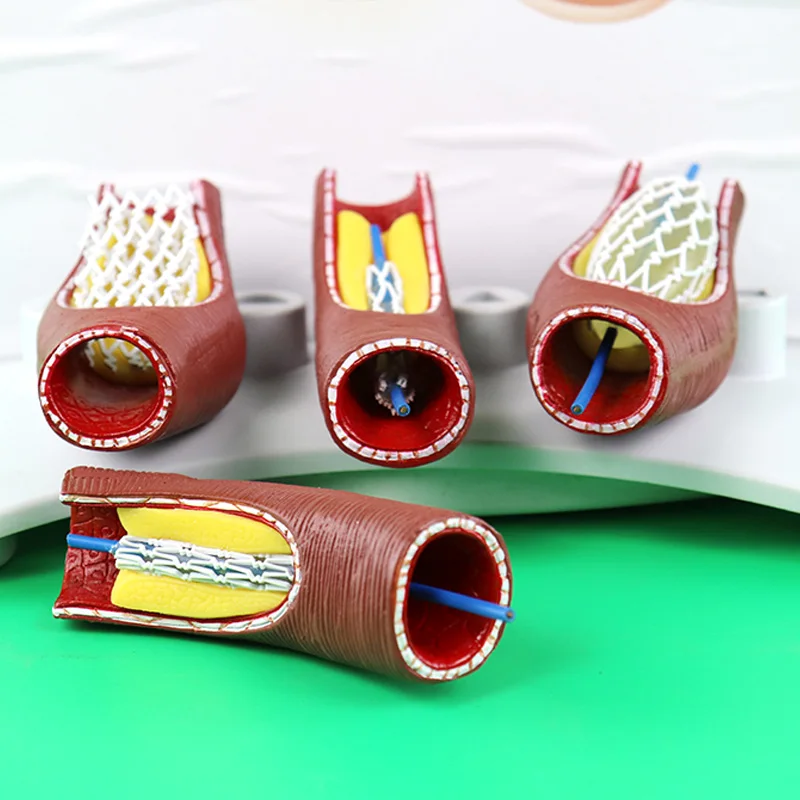 Human Vascular Coronary Heart Disease Stent Installation Process Bypass Bracket Installation Demo Blockage