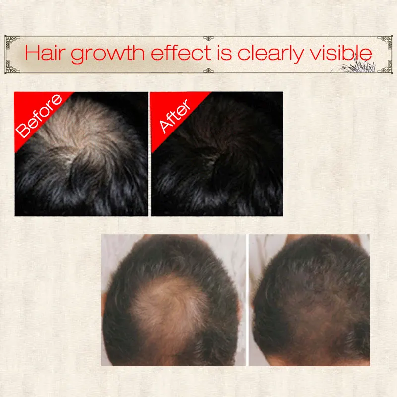 Sevich 30Ml Hebal น้ำมัน Essence Fast Hair Growth สเปรย์รักษาผมร่วงช่วยให้สำหรับ Hair Growth Hair Care