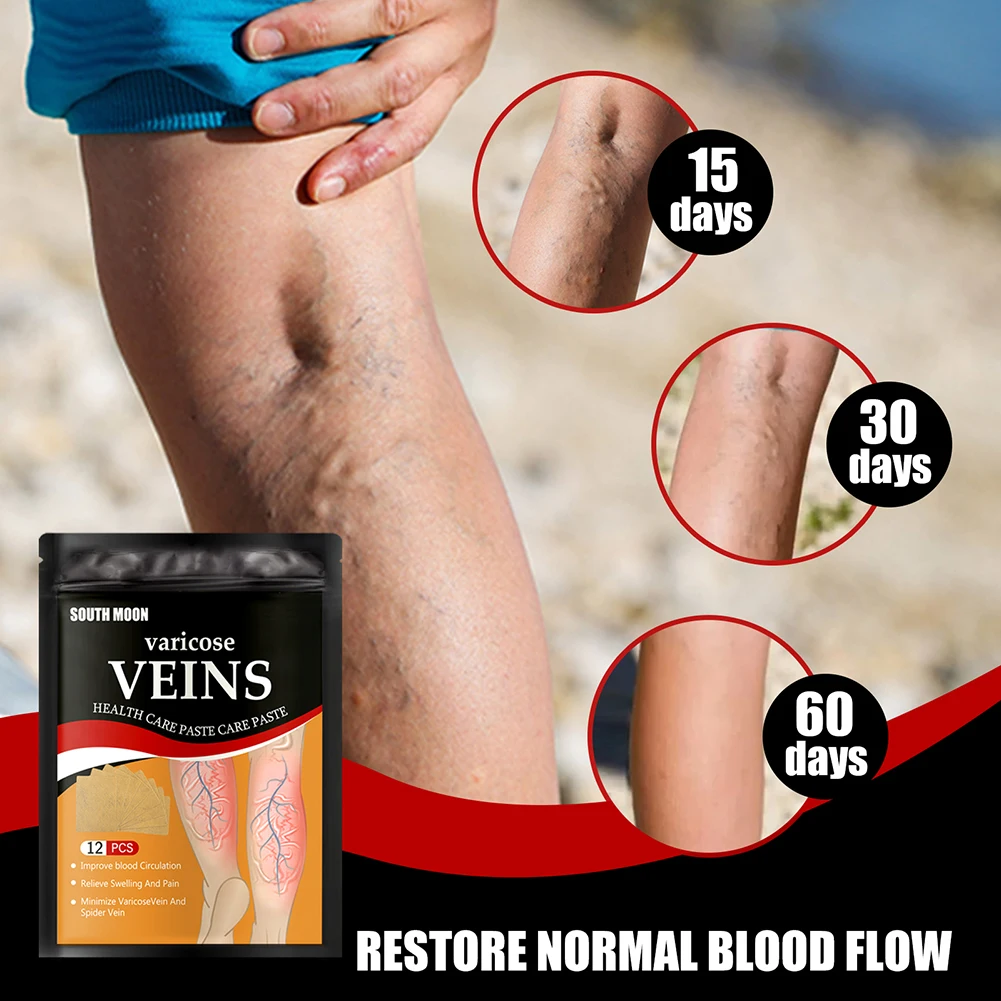 12pcs Varicose Veins Treatment Patch Relieve Leg Pain Spider Vein Removal Plaster Promote Smooth Blood Circulation for Men Women