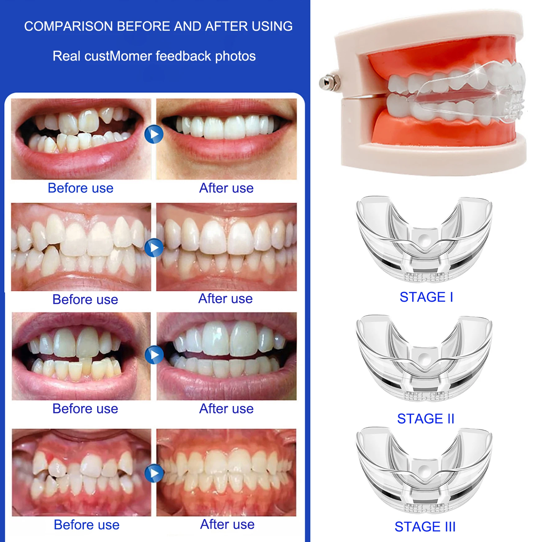 Aparatos de ortodoncia, aparatos dentales, entrenador de alineación de dientes con sonrisa, retenedor de dientes de silicona instantáneo, protector bucal, bandeja para dientes