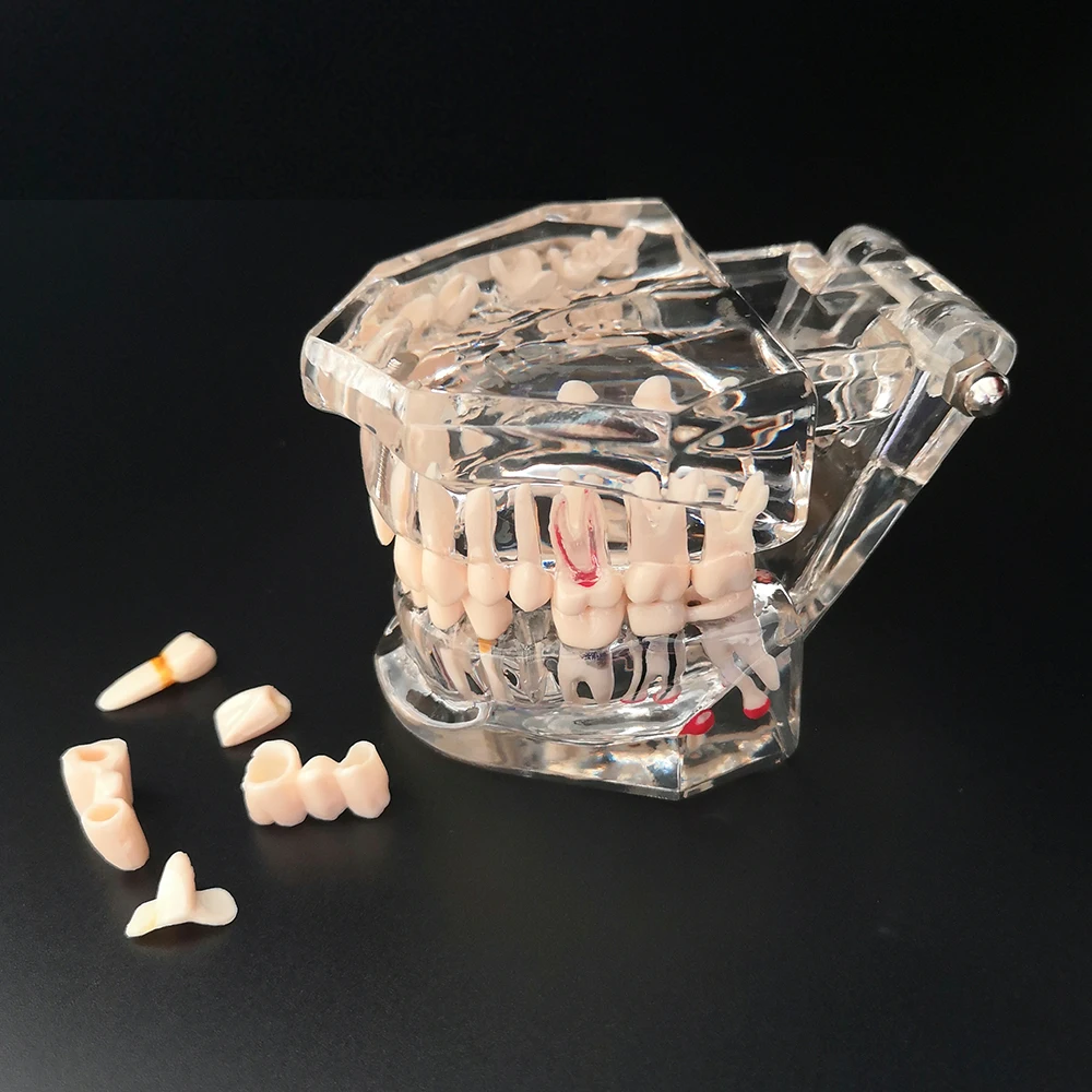 Neues Dentalmodell für Zahnimplantate, Restaurationsbrücken, Lehrmaterial für Medizinische Wissenschaft, Krankheiten, Zahnärzte und Zahnmedizinprodukte – Detail 1