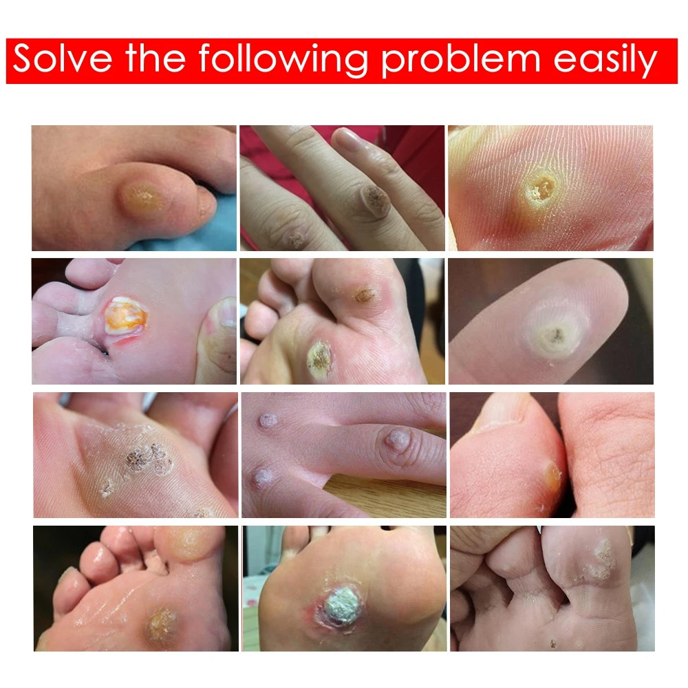 6/12/18pcs Medical Corn Plaster Foot Corn Removal Warts Detox Adhesive Patches Feet Care Calluses Callosity Clavus Remove Tool