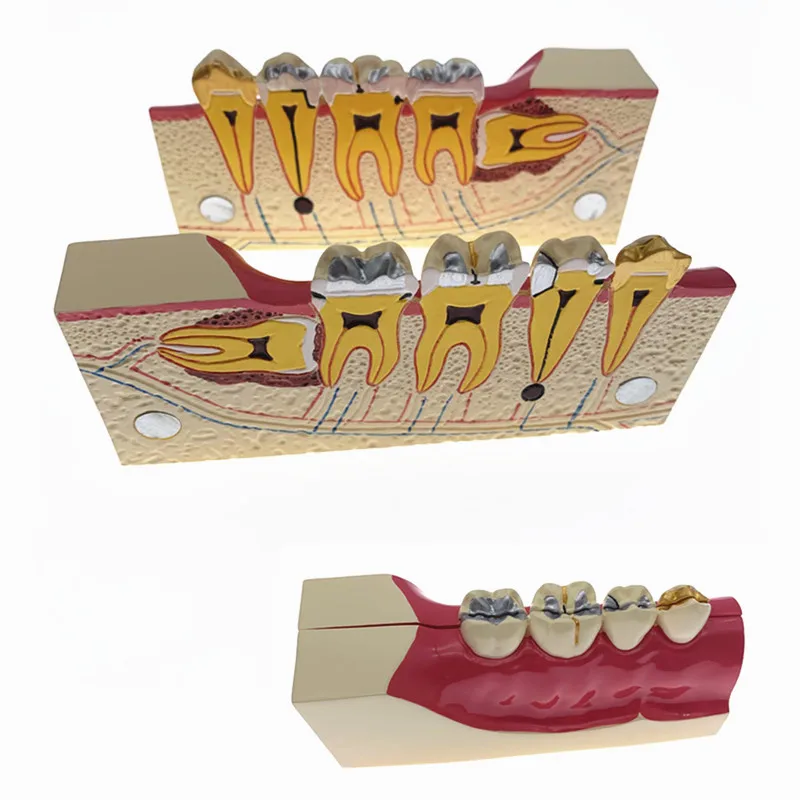 Dental Disease Teeth Anatomy Study Model Molar Cross Section Decomposition model of lower right posterior teeth model