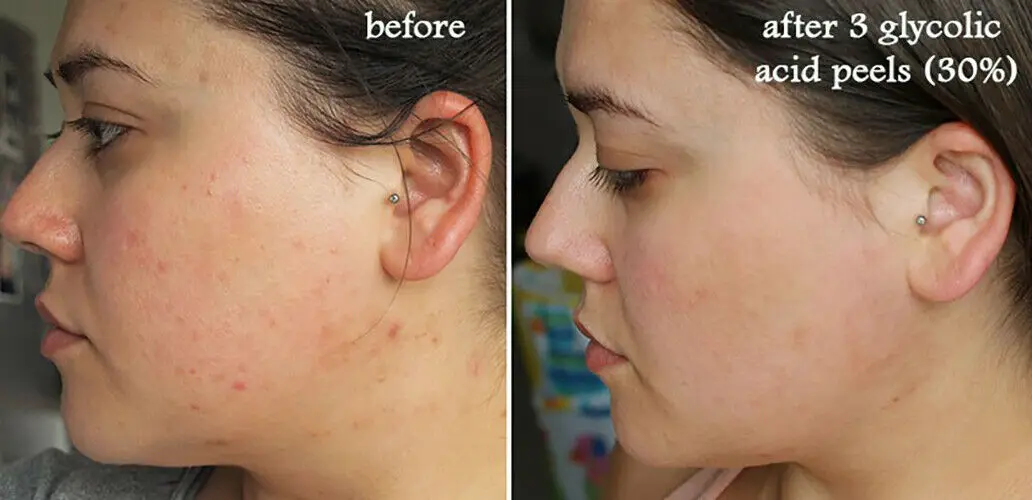 Casca de ácido glicólico 10% 20% 30% 40% 50% 60% 70% casca química intensa para a hiperpigmentação da acne rosácea