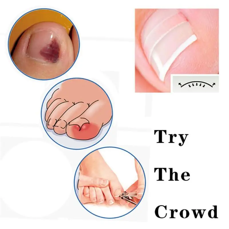 100pcs/box Ingrown Pedicure Toenail Straightening Clip Toe Nail Sticker Brace Toenials Thick Correction Patch Foot Care Tools