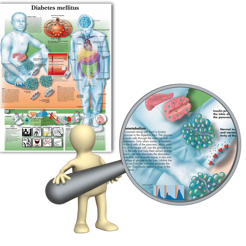 Imagem -02 - Wangart Anatômico Poster Diabetes Mellitus Gráfico Impressão em Tela Imagem da Parede para a Educação Médica