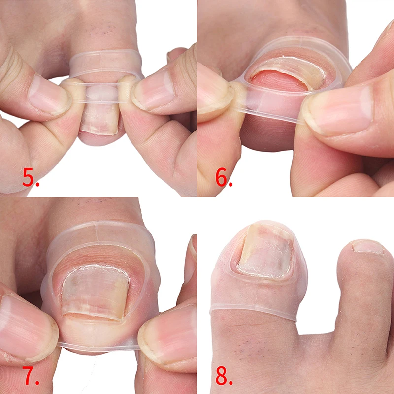 2pcs Silicone Ingrown Toenail Correction Invisible Ingrown Toe Nail Treatment Elastic Straightening Clip Brace Pedicure Tool