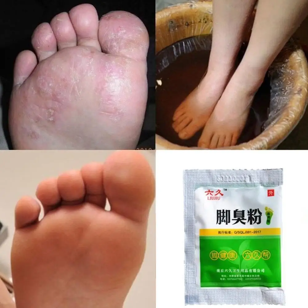 Fungal Infections Foot Bath Powder Feet Care  Foot odor Foot itch Athlete's Foot Foot Odor Sweat Itching Peeling Beriberi  Foot