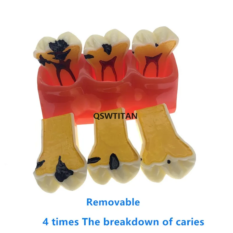 4Times Caries Models Caries teeth model for showing the progress of caries,fistula Teaching Research Model