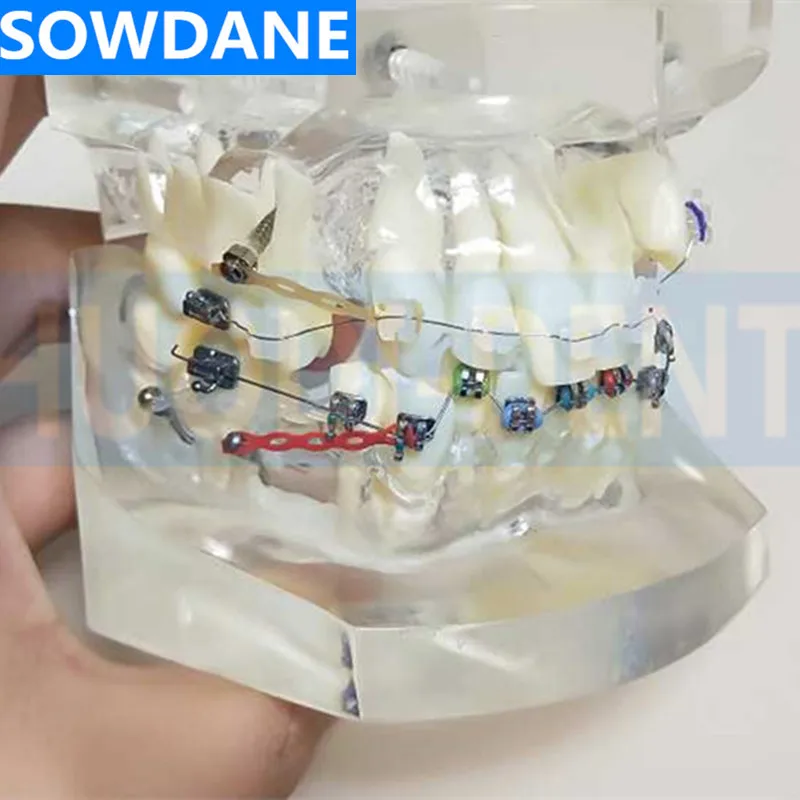 

Transparent Dental Orthodontic Mallocclusion Model with Mental Ceramic Brackets Archwire buccal tube for Patient Communication