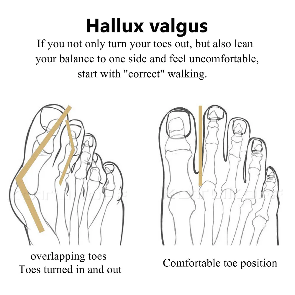 2Pcs Silicone Foot Toe Separator Adjuster Hallux Valgus Pedicure Corrector Feet Care Bunion Bone Thumb Valgus Protector Tool
