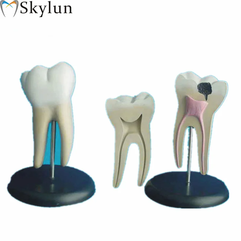 Dental Advanced medical teaching human body large - scale healthy tooth and human tooth decay model human dental model SL719