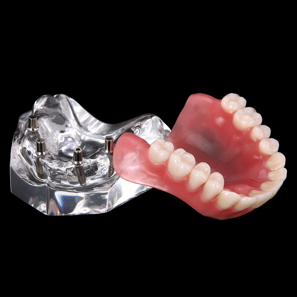 Modelo Mandibular Dental Removível com Implante, Dentes Overdenture, Dentes Superior e Inferior, Dente Ensino e Estudo