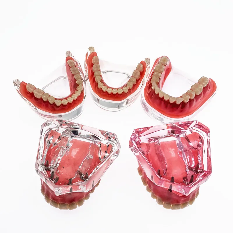 Overdenture implant teeth model Denture Teeth model with implant Dental ClinicTeaching Model