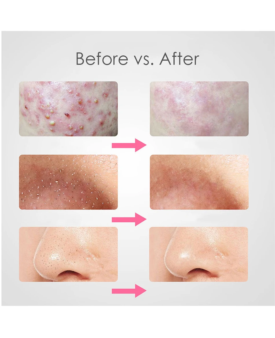 4 ชิ้น/เซ็ต Blackhead Comedone สิวสิว Blackhead Remover เครื่องมือช้อนสําหรับ Face Skin Care เครื่องมือเข็มทําความสะอาดรูขุมขนบนใบหน้า